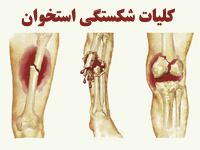 پاورپوینت کلیات شکستگی استخوان و علائم تشخیص انواع شکستگی